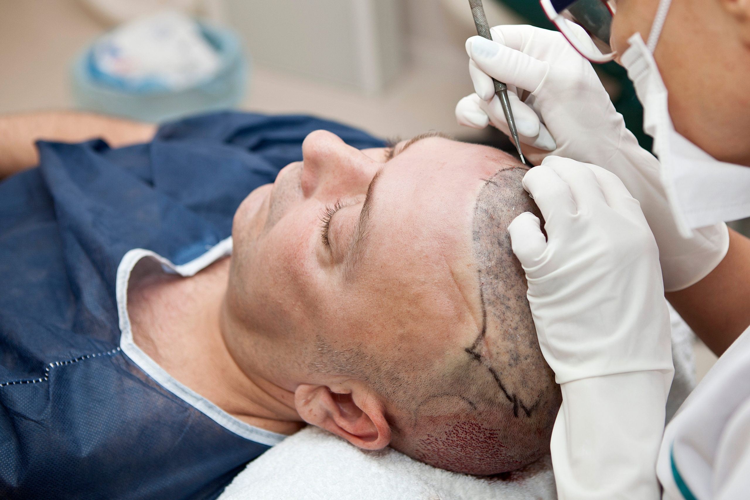 hair transplants in turkey